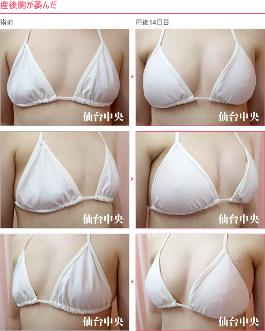 産後胸が萎んだ 症例写真