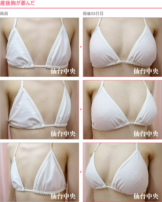 産後胸が萎んだ 症例写真