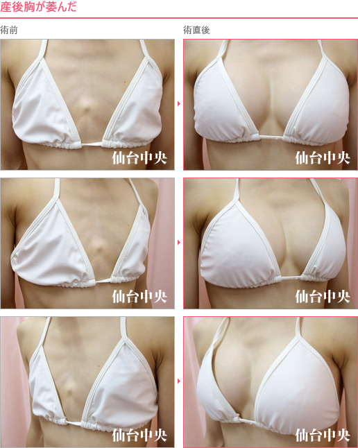 産後胸が萎んだ 症例写真