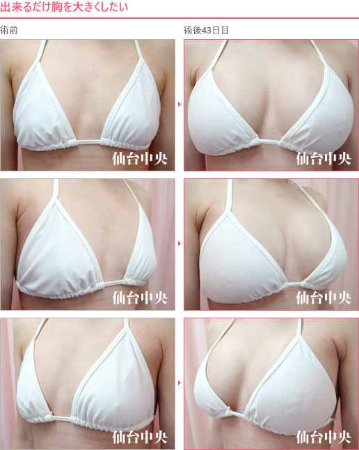 出来るだけ胸を大きくしたい 症例写真