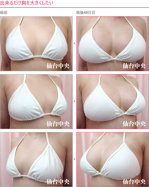出来るだけ胸を大きくしたい 症例写真