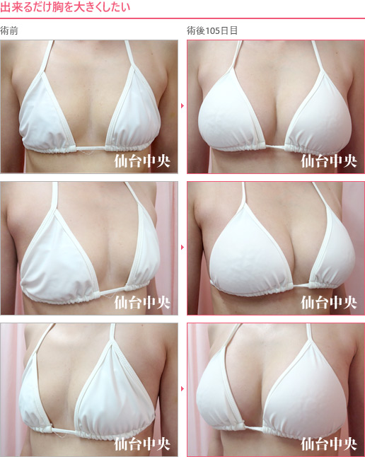 出来るだけ胸を大きくしたい 症例写真