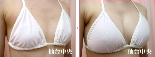 形の綺麗な胸 症例写真2