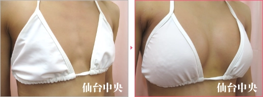 形の綺麗な胸 症例写真2