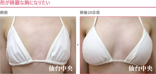 形の綺麗な胸 症例写真