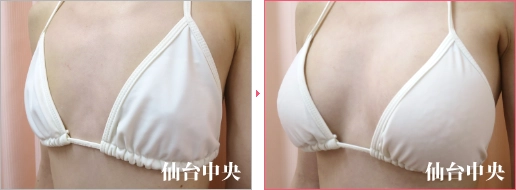 形の綺麗な胸 症例写真3