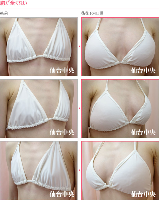 胸が全くない 症例写真4