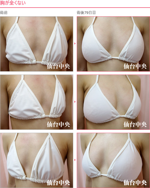 胸が全くない 症例写真5