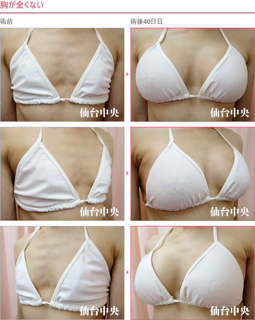 胸が全くない 症例写真6