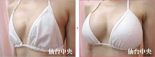 他院ヒアルロン酸豊胸の修正症例写真、術前・術後70日の比較 - 30代女性、左前