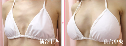 他院ヒアルロン酸豊胸の修正症例写真、術前・術後26日の比較 - 40代女性、左前