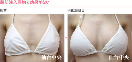 脂肪注入豊胸で効果がない 症例写真