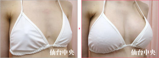 脂肪注入豊胸で効果がない 症例写真2