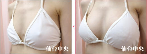 脂肪注入豊胸で効果がない 症例写真3