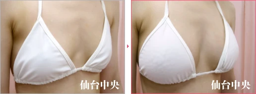 派手な水着を着たい 症例写真2