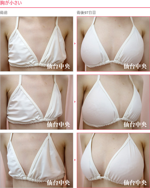 胸が小さい 症例写真3