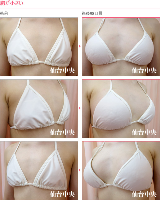 胸が小さい 症例写真4