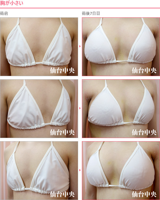 胸が小さい 症例写真5