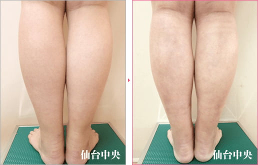 下半身の脂肪吸引 症例写真6