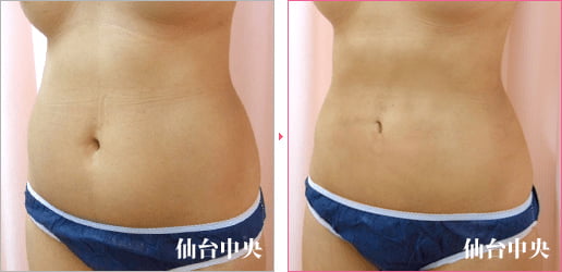 腹部脂肪吸引 症例写真3