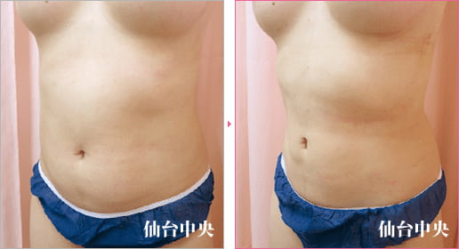 上下腹部側腹部脂肪吸引 症例写真3