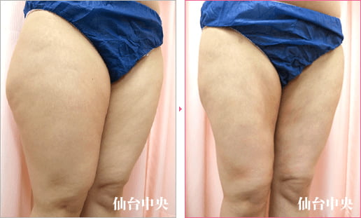大腿臀部脂肪吸引 症例写真2