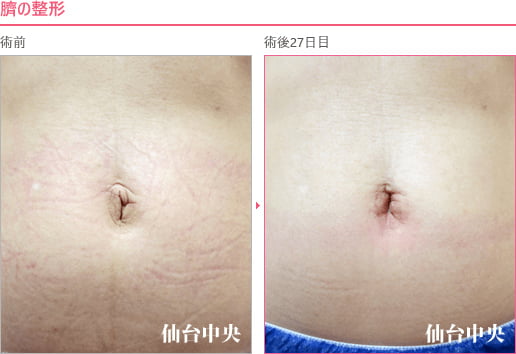 臍の整形 症例写真