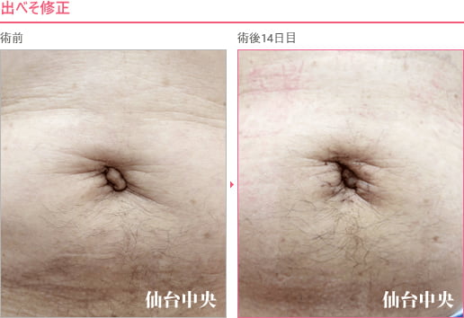 出べそ修正 症例写真